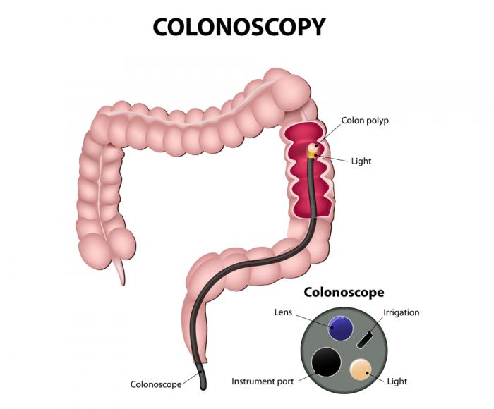 A Colonoscopy Diagram